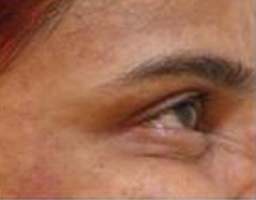 Botox Treatment