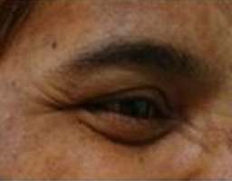 Botox Treatment