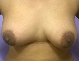 Breast Augmentation By Fat Grafting