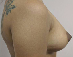 Breast Augmentation By Fat Grafting