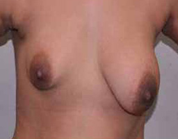 Breast Augmentation By Fat Grafting