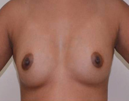 Breast Augmentation By Fat Grafting