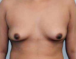 Breast Augmentation By Fat Grafting