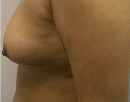 Breast Augmentation By Fat Grafting