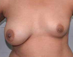 Breast Augmentation By Fat Grafting