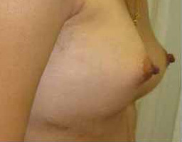 Breast Augmentation By Fat Grafting