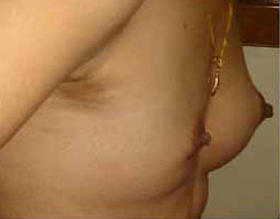 Breast Augmentation By Fat Grafting