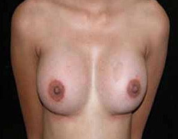 Breast Implant
