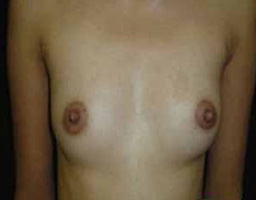 Breast Implant