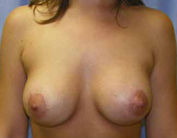 Breast Implant