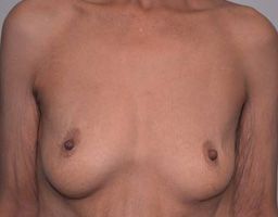 Breast Implant