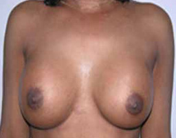 Breast Implant