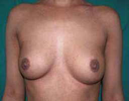 Breast Implant