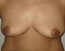 Breast Implant