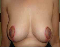Breast Lift