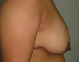 Breast Lift