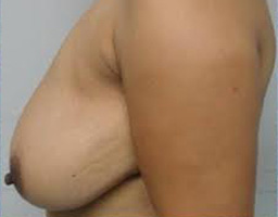 Breast Lift