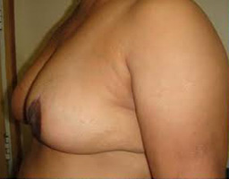 Breast Lift