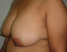 Breast Lift
