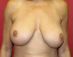 Breast Lift