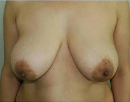 Breast Lift