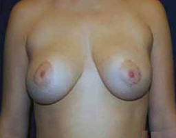 Breast Reduction