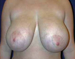 Breast Reduction