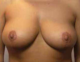 Breast Reduction