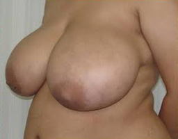 Breast Reduction