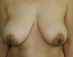 Breast Reduction