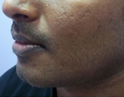 Chin Reshaping