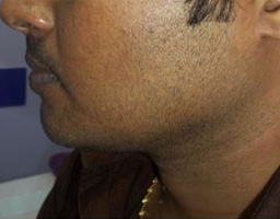 Chin Reshaping