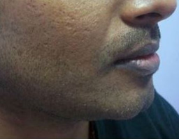 Chin Reshaping