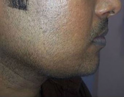 Chin Reshaping