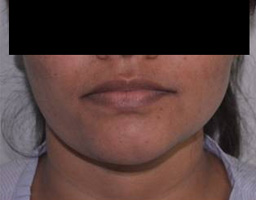 Chin Reshaping