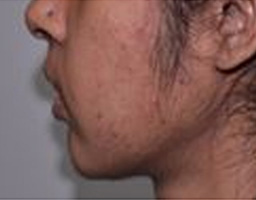 Chin Reshaping