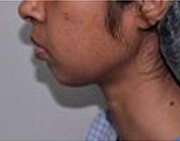 Chin Reshaping