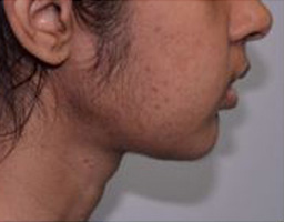 Chin Reshaping