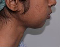 Chin Reshaping
