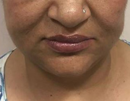 Face Lift