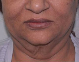 Face Lift