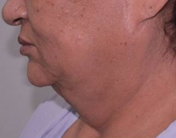 Face Lift