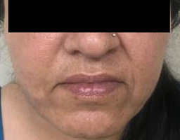 Face Lift