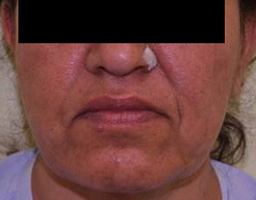 Face Lift