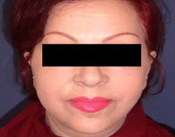 Face Lift
