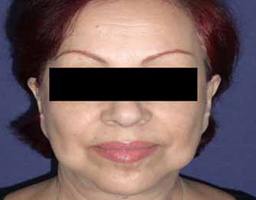 Face Lift