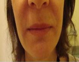 Dermal Fillers Treatment