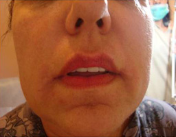 Dermal Fillers Treatment