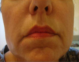 Dermal Fillers Treatment