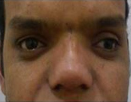 Dermal Fillers Treatment